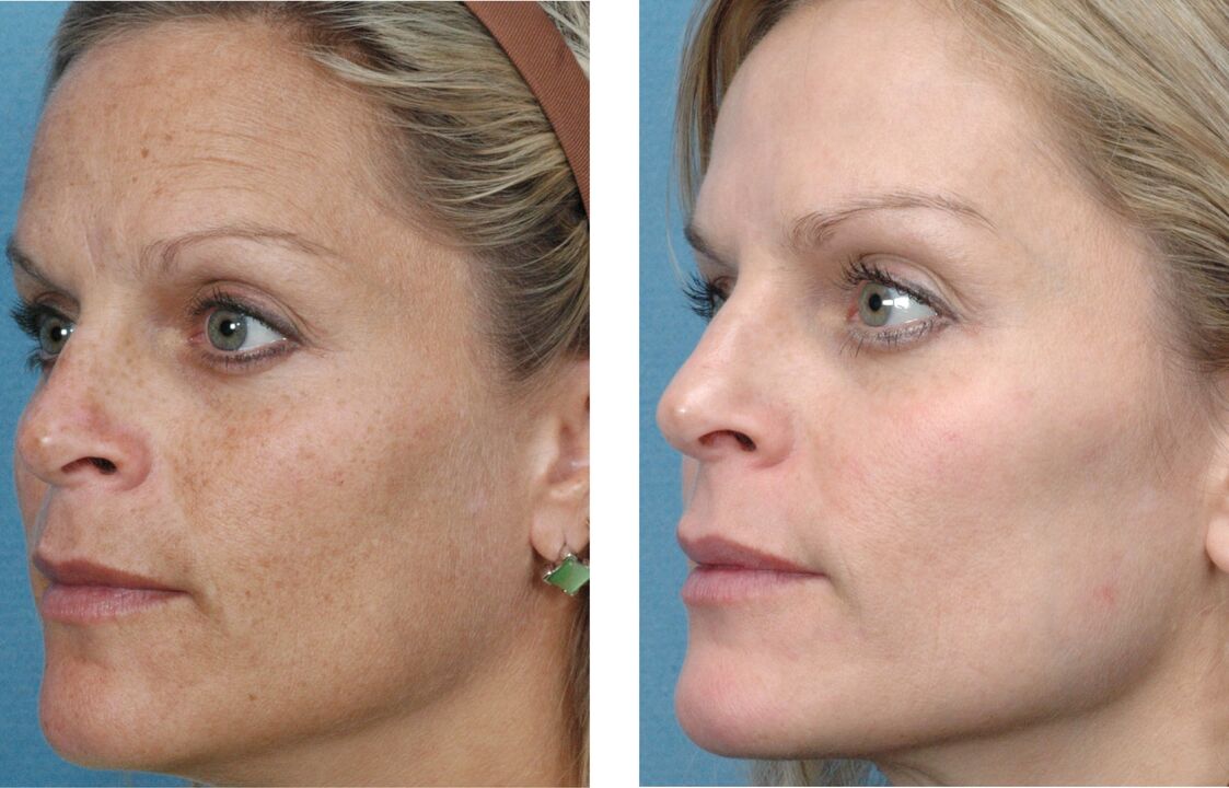 φωτογραφία πριν και μετά την αναζωογόνηση του δέρματος 1