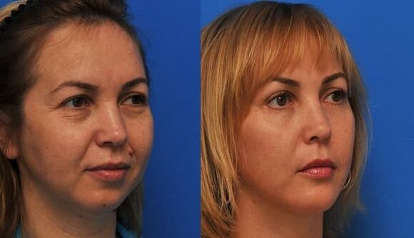 πριν και μετά την αναζωογόνηση του δέρματος με φωτογραφία σύσφιξης 1