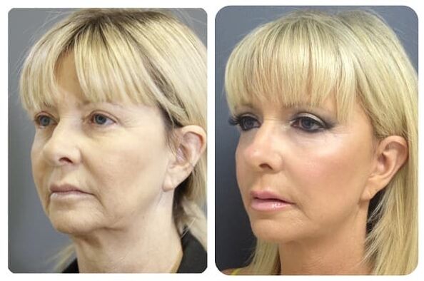 πριν και μετά την αναζωογόνηση του δέρματος με φωτογραφία σύσφιξης 2
