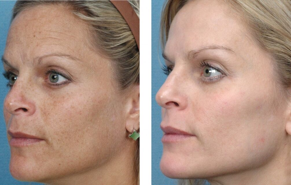 πριν και μετά την αναζωογόνηση του δέρματος