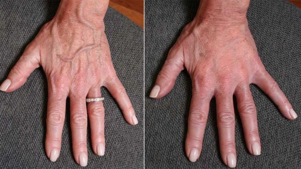 πλαστικό περίγραμμα, φωτογραφία αναζωογόνησης χεριών 1 πριν και μετά