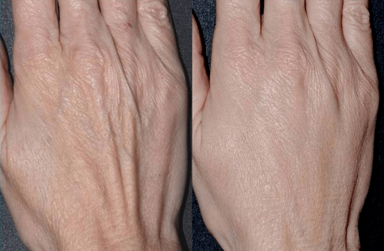πλαστικό περίγραμμα, φωτογραφία αναζωογόνησης χεριών 2 πριν και μετά